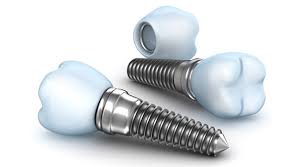 innovacion-implantes-dentales-3