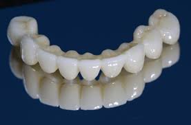 coronas-zirconio-emax-disilicato-litio-2