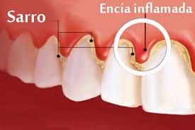gingivitis-1