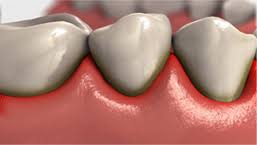 gingivitis-3