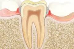 gingivitis-4