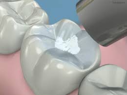selladores-dentales-1