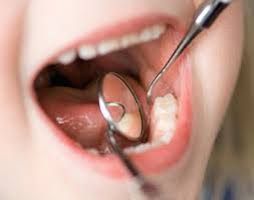 Técnica del sellado en molares