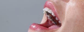 ortodoncia-lingual-1