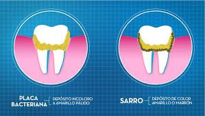 diferencias-sarro-placa-bacteriana-1